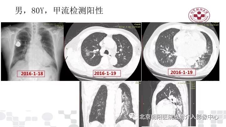 【PPT】病毒性肺炎影像诊断思路