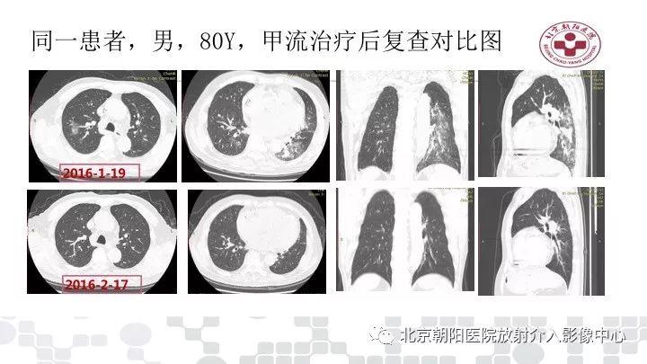 【PPT】病毒性肺炎影像诊断思路