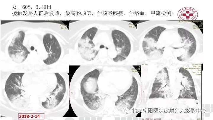 【PPT】病毒性肺炎影像诊断思路