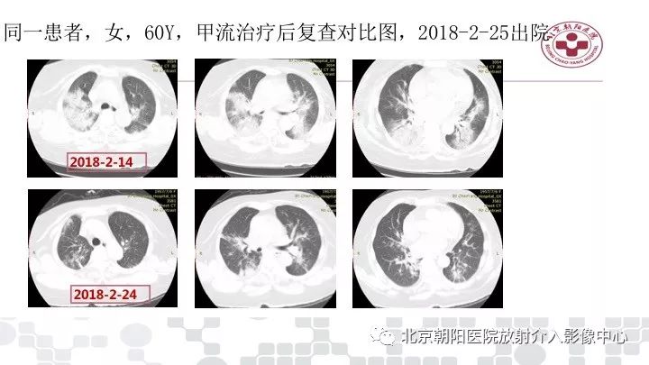 【PPT】病毒性肺炎影像诊断思路