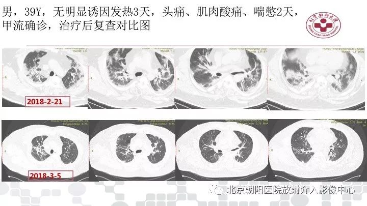 【PPT】病毒性肺炎影像诊断思路