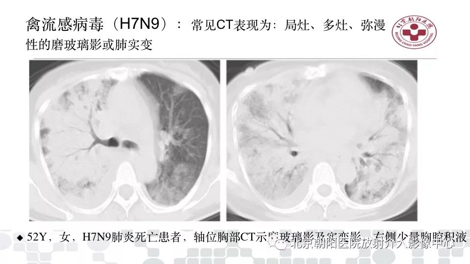 【PPT】病毒性肺炎影像诊断思路