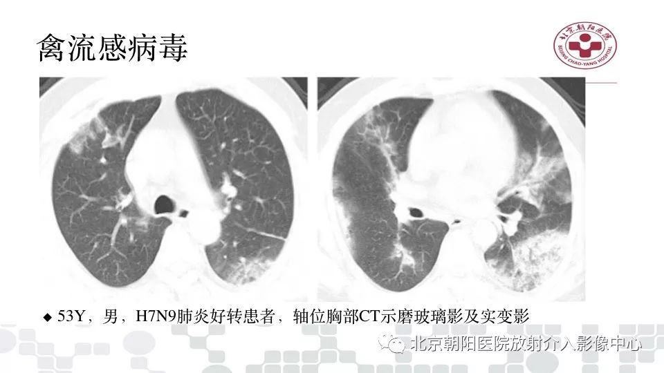 【PPT】病毒性肺炎影像诊断思路