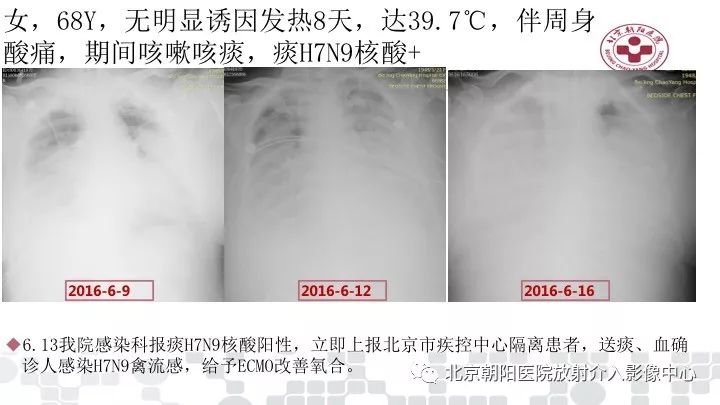 【PPT】病毒性肺炎影像诊断思路