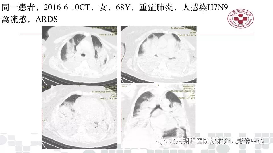 【PPT】病毒性肺炎影像诊断思路