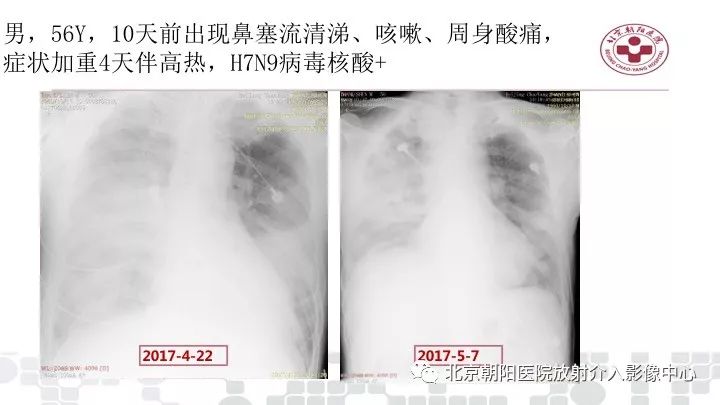 【PPT】病毒性肺炎影像诊断思路