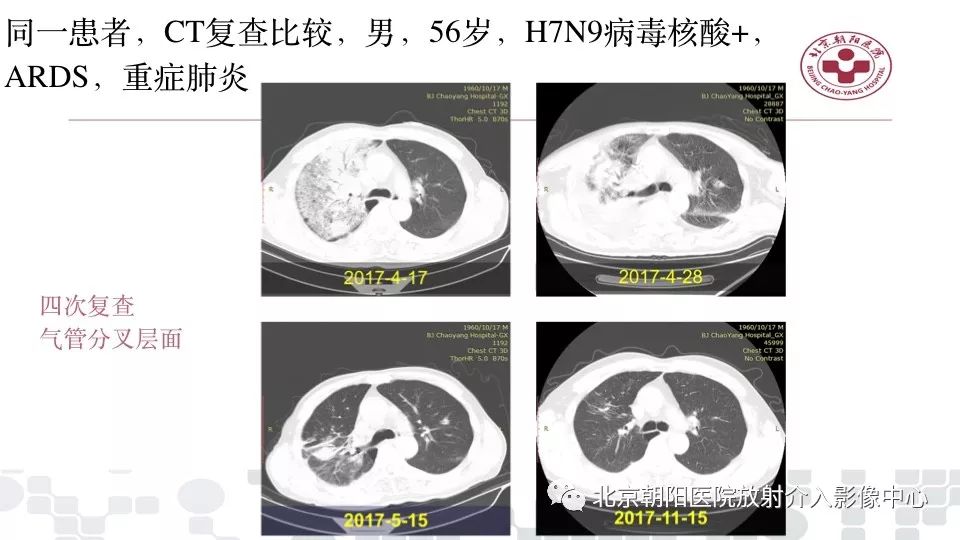 【PPT】病毒性肺炎影像诊断思路