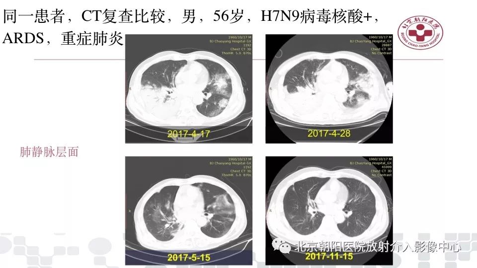 【PPT】病毒性肺炎影像诊断思路