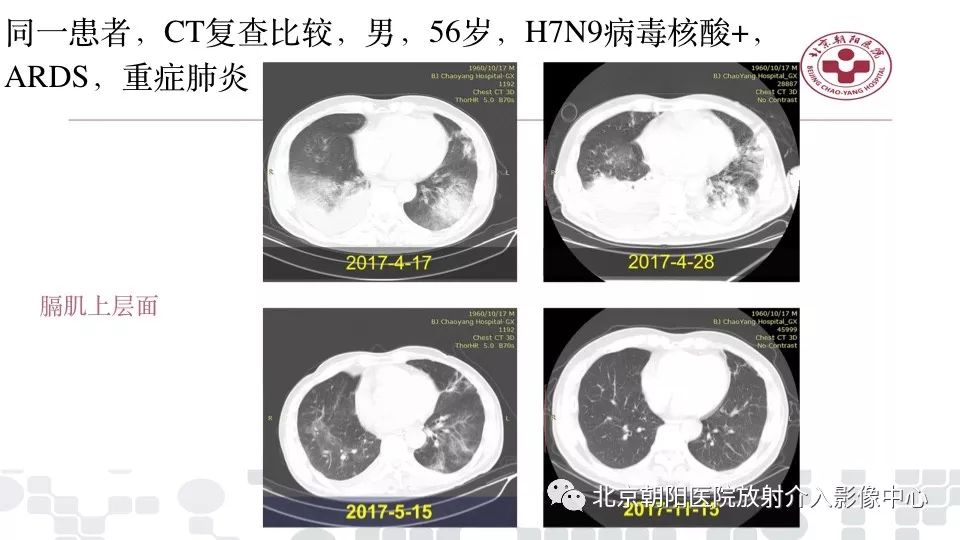 【PPT】病毒性肺炎影像诊断思路