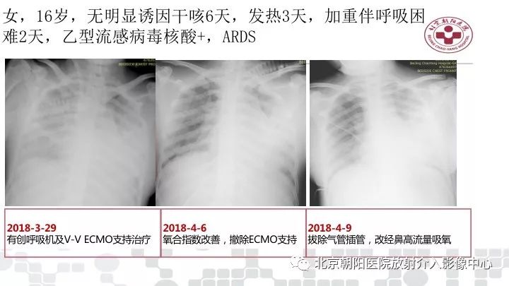 【PPT】病毒性肺炎影像诊断思路