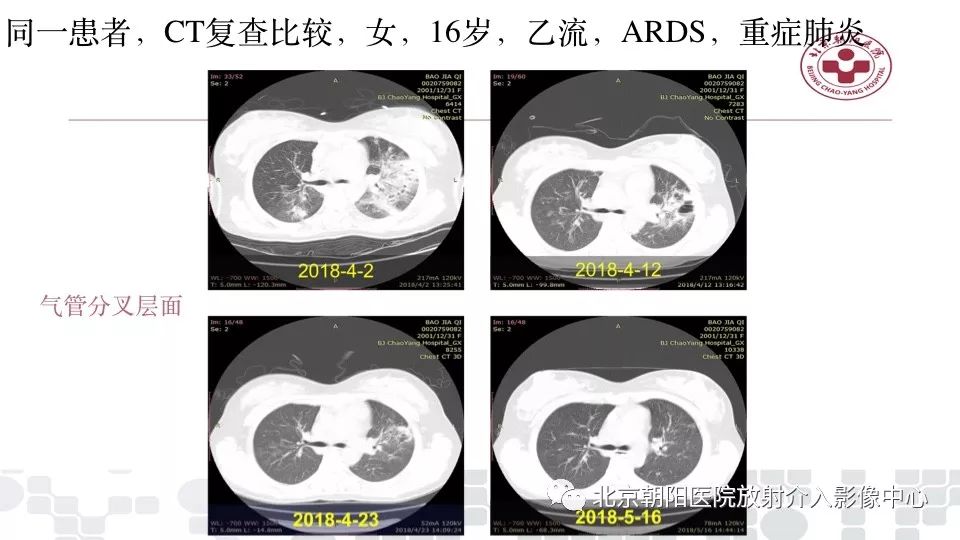 【PPT】病毒性肺炎影像诊断思路