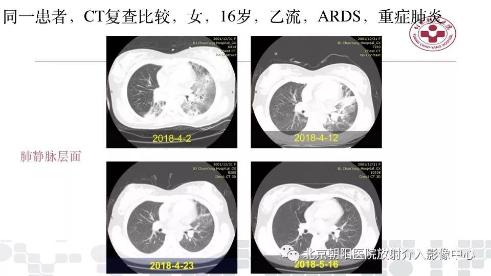 【PPT】病毒性肺炎影像诊断思路