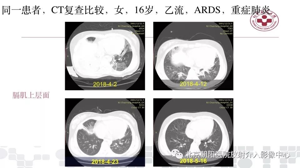 【PPT】病毒性肺炎影像诊断思路