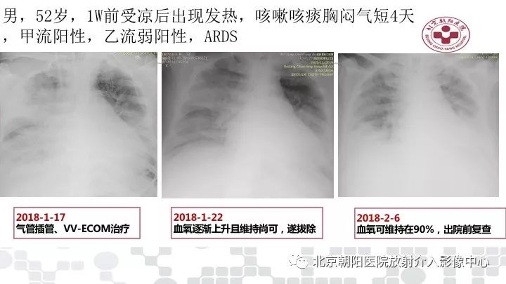 【PPT】病毒性肺炎影像诊断思路