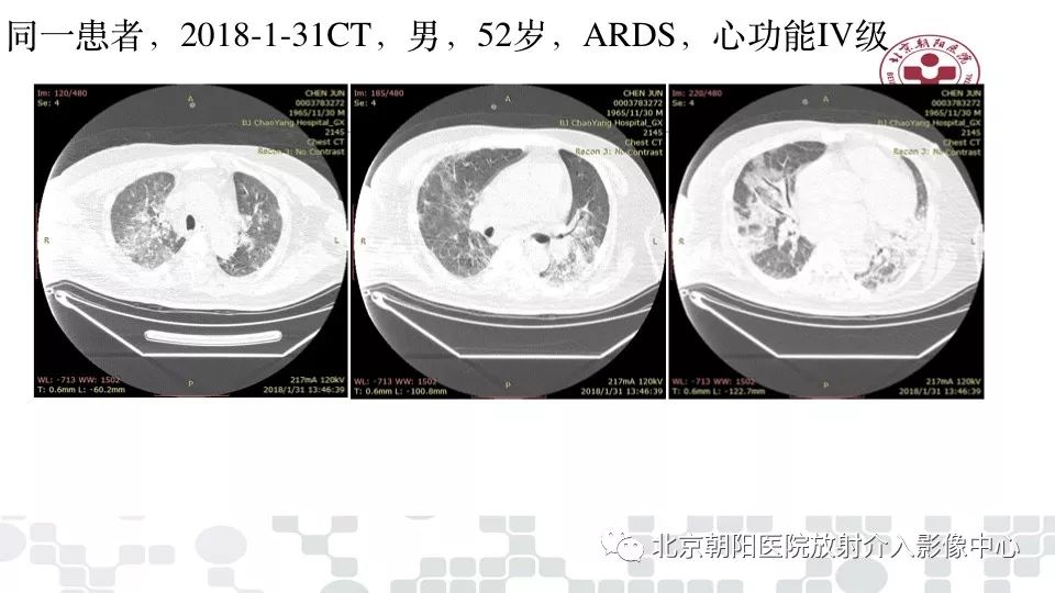 【PPT】病毒性肺炎影像诊断思路