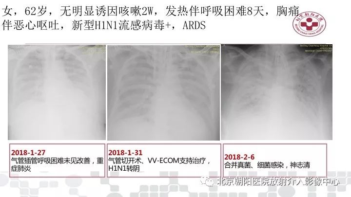 【PPT】病毒性肺炎影像诊断思路