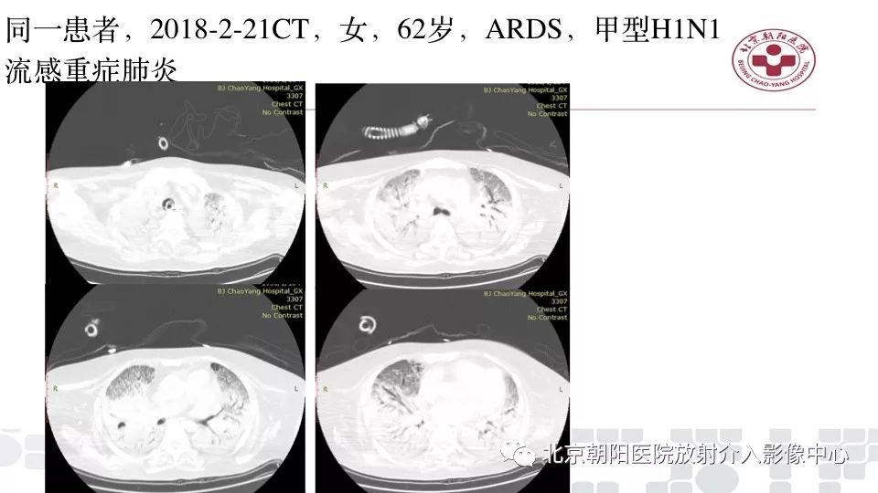 【PPT】病毒性肺炎影像诊断思路