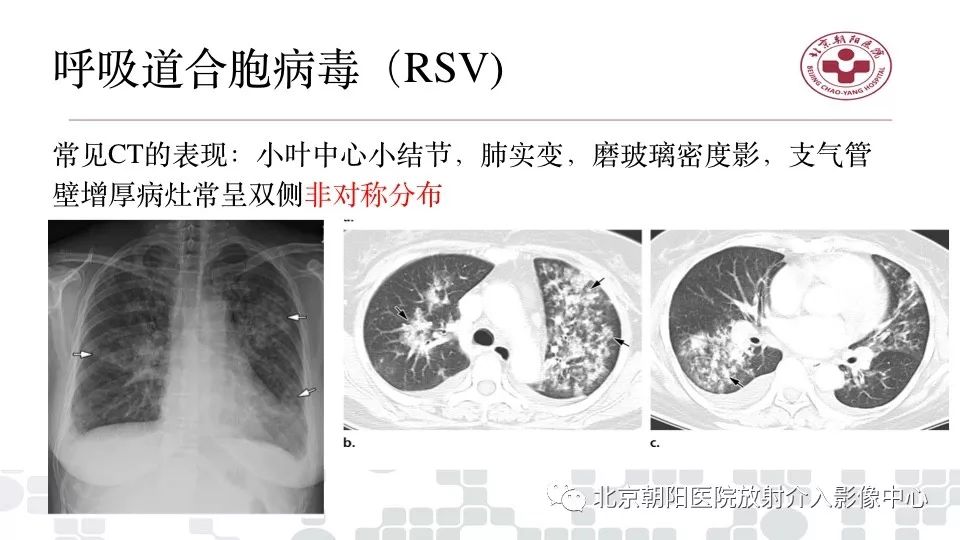 【PPT】病毒性肺炎影像诊断思路