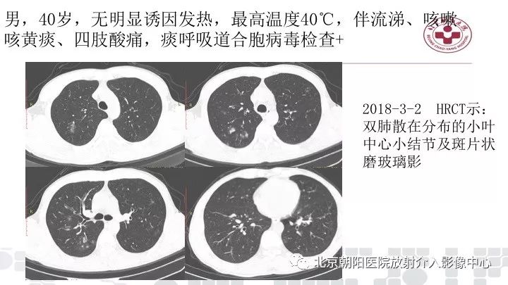 【PPT】病毒性肺炎影像诊断思路