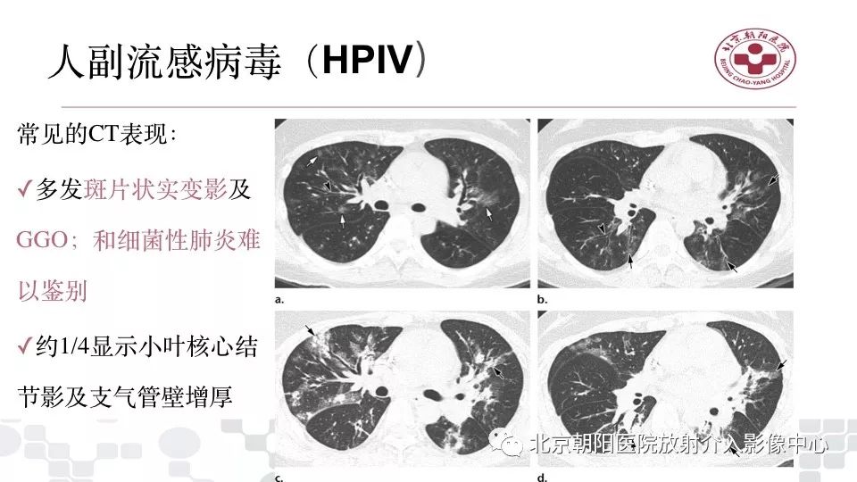 【PPT】病毒性肺炎影像诊断思路