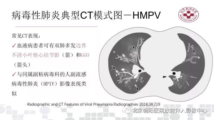 【PPT】病毒性肺炎影像诊断思路
