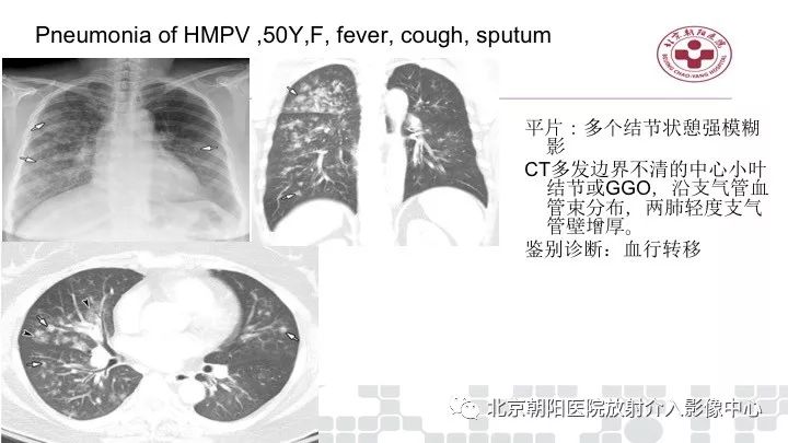 【PPT】病毒性肺炎影像诊断思路