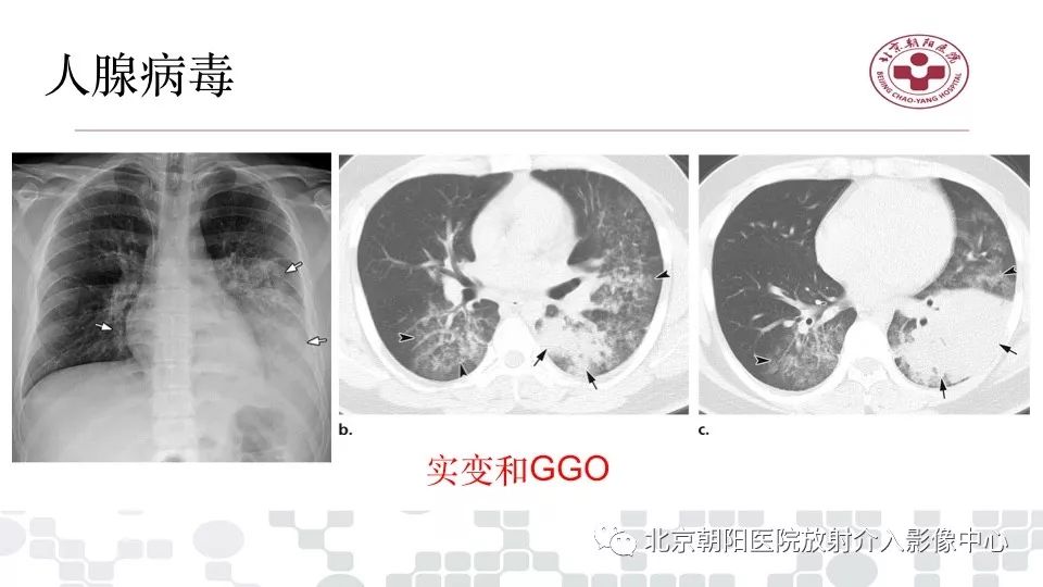 【PPT】病毒性肺炎影像诊断思路