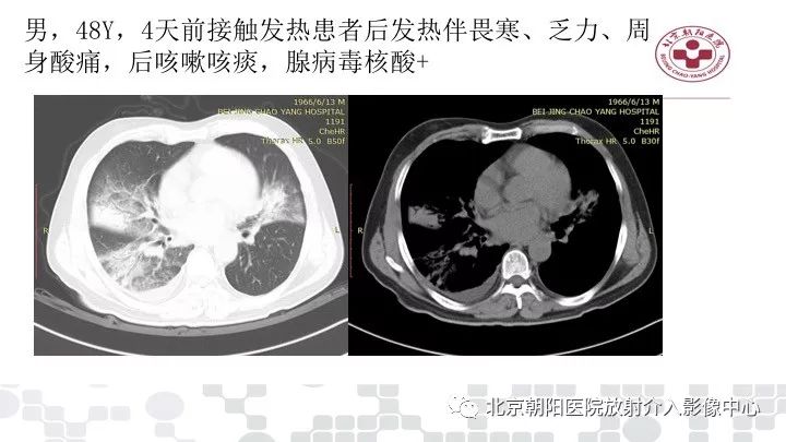 【PPT】病毒性肺炎影像诊断思路