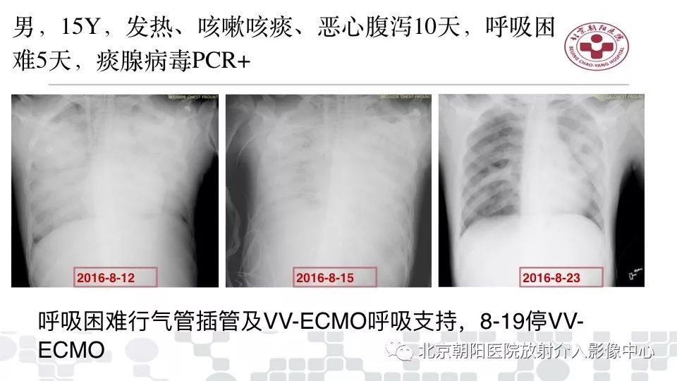 【PPT】病毒性肺炎影像诊断思路