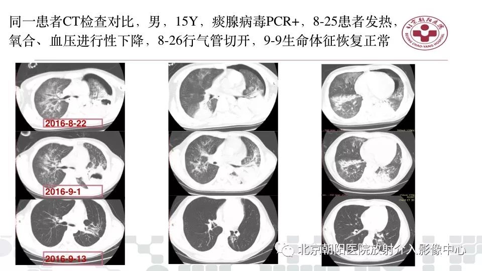 【PPT】病毒性肺炎影像诊断思路