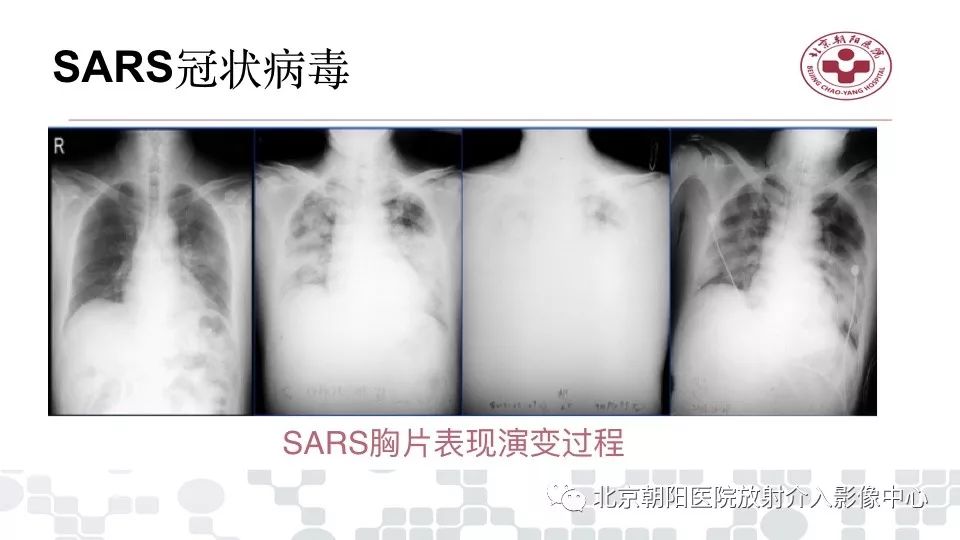 【PPT】病毒性肺炎影像诊断思路