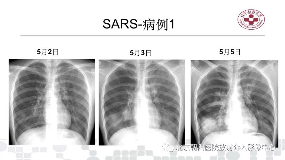 【PPT】病毒性肺炎影像诊断思路
