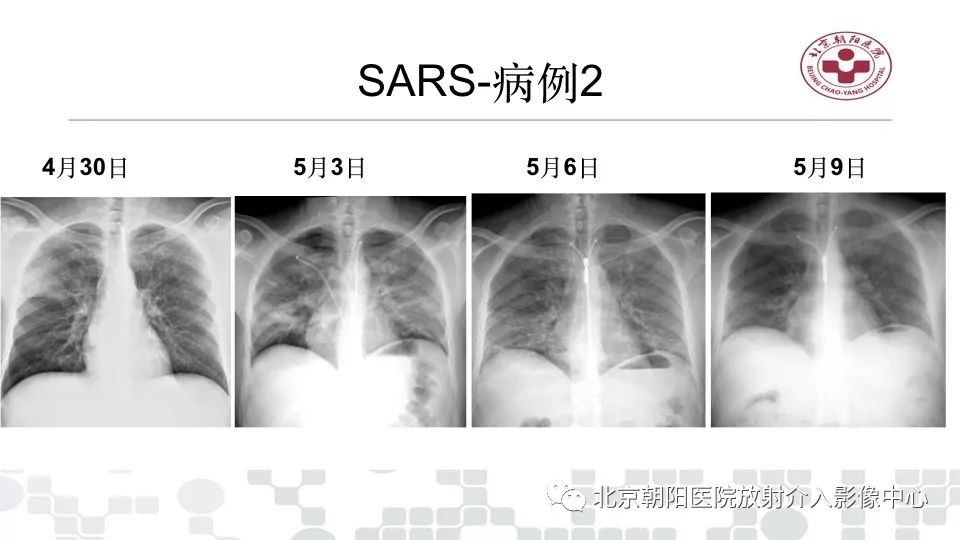 【PPT】病毒性肺炎影像诊断思路