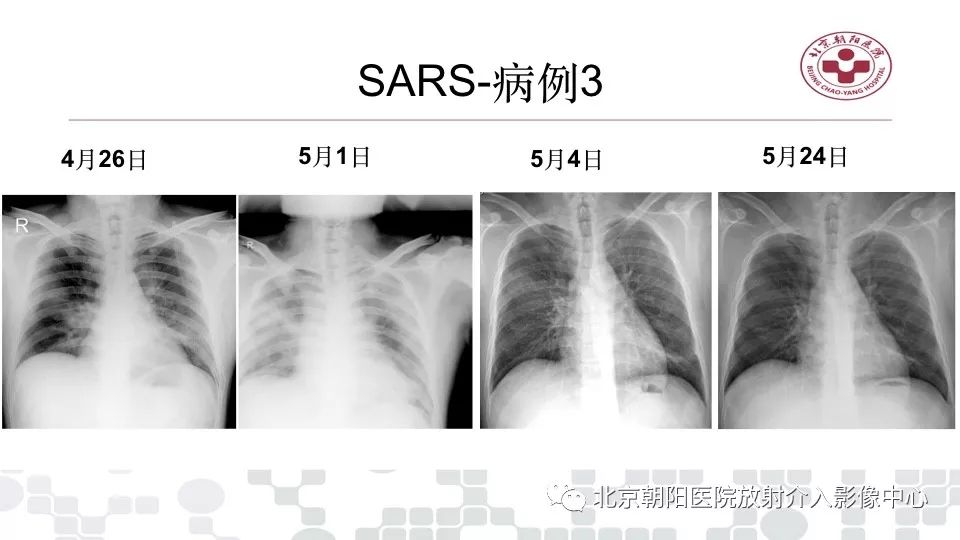 【PPT】病毒性肺炎影像诊断思路