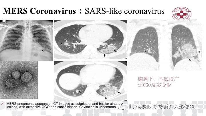 【PPT】病毒性肺炎影像诊断思路