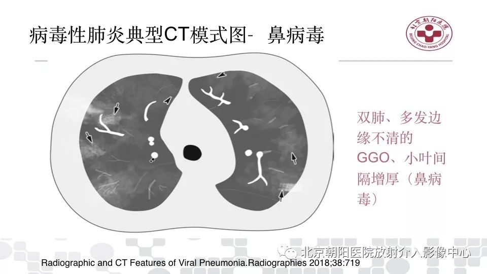 【PPT】病毒性肺炎影像诊断思路