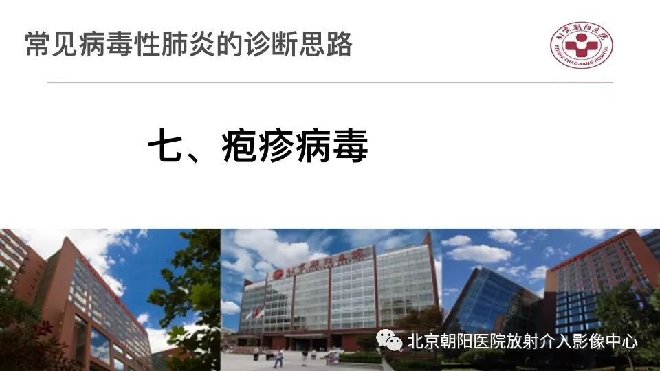 【PPT】病毒性肺炎影像诊断思路
