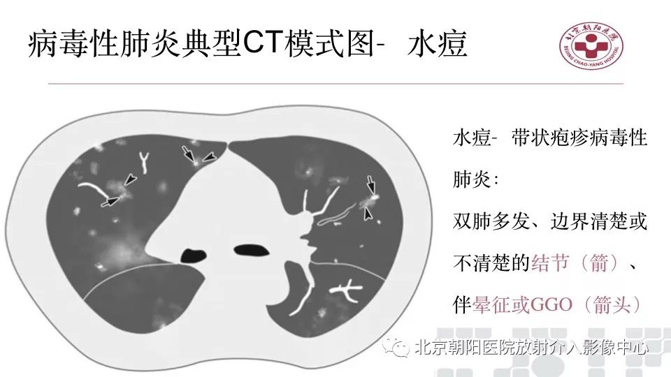 【PPT】病毒性肺炎影像诊断思路