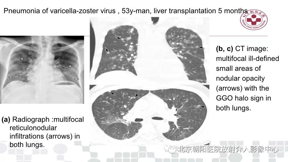 【PPT】病毒性肺炎影像诊断思路