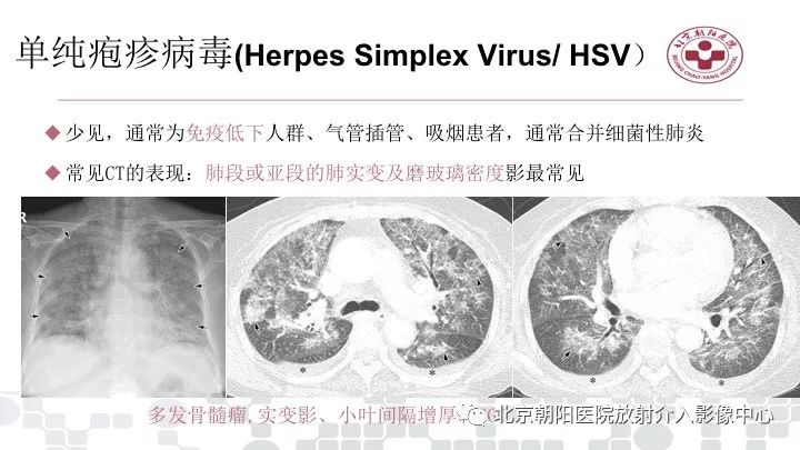 【PPT】病毒性肺炎影像诊断思路