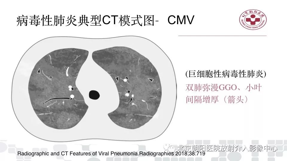 【PPT】病毒性肺炎影像诊断思路