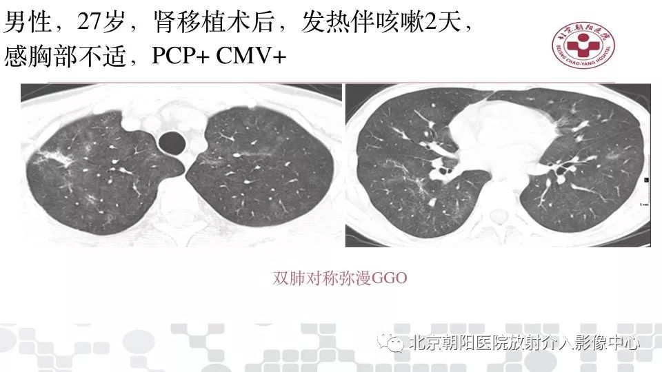 【PPT】病毒性肺炎影像诊断思路