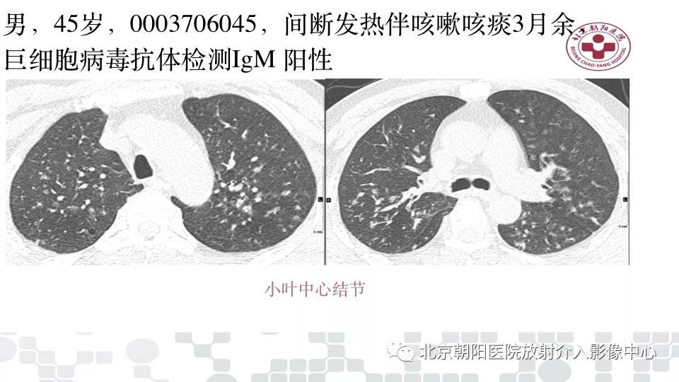 【PPT】病毒性肺炎影像诊断思路