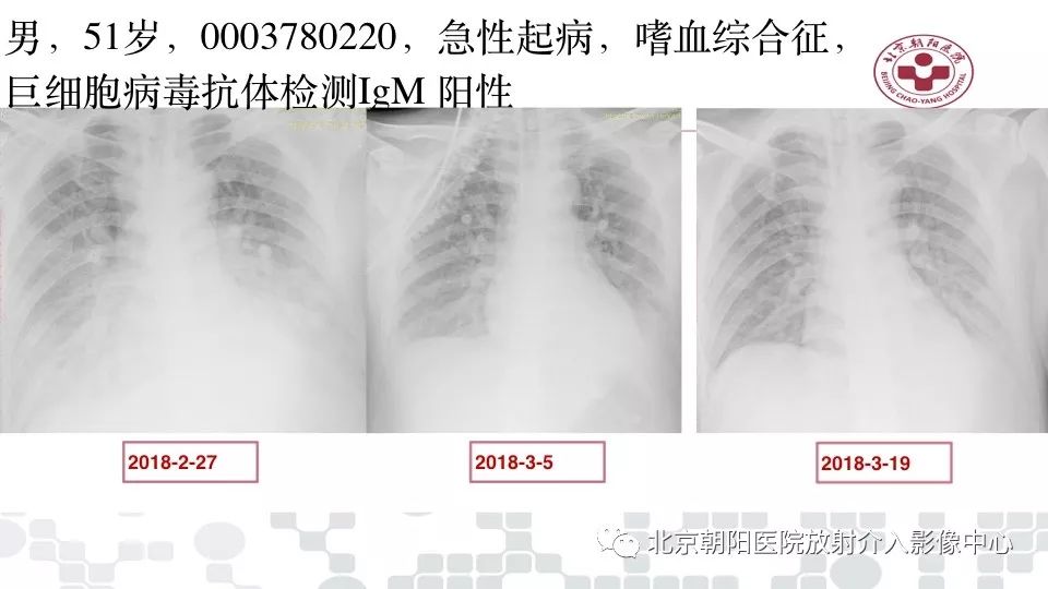 【PPT】病毒性肺炎影像诊断思路