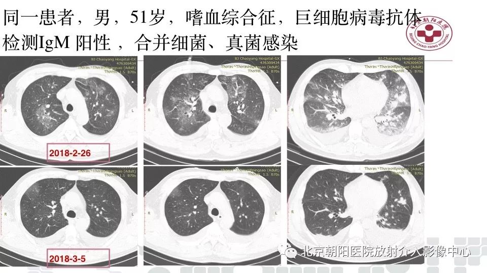 【PPT】病毒性肺炎影像诊断思路