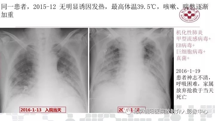 【PPT】病毒性肺炎影像诊断思路