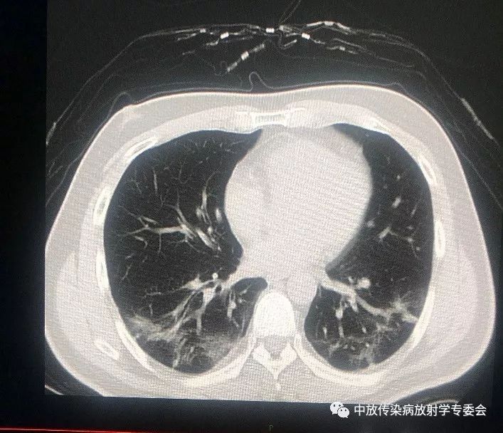 李宏军教授团队剖析:确诊19-nCoV 肺炎的肺部CT表现 李宏军教授团队剖析:确诊19-nCoV 肺炎的肺部CT表现
