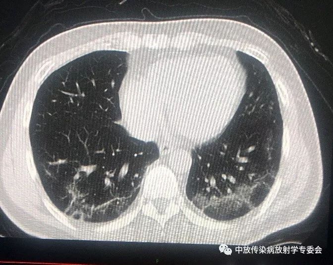 李宏军教授团队剖析:确诊19-nCoV 肺炎的肺部CT表现 李宏军教授团队剖析:确诊19-nCoV 肺炎的肺部CT表现