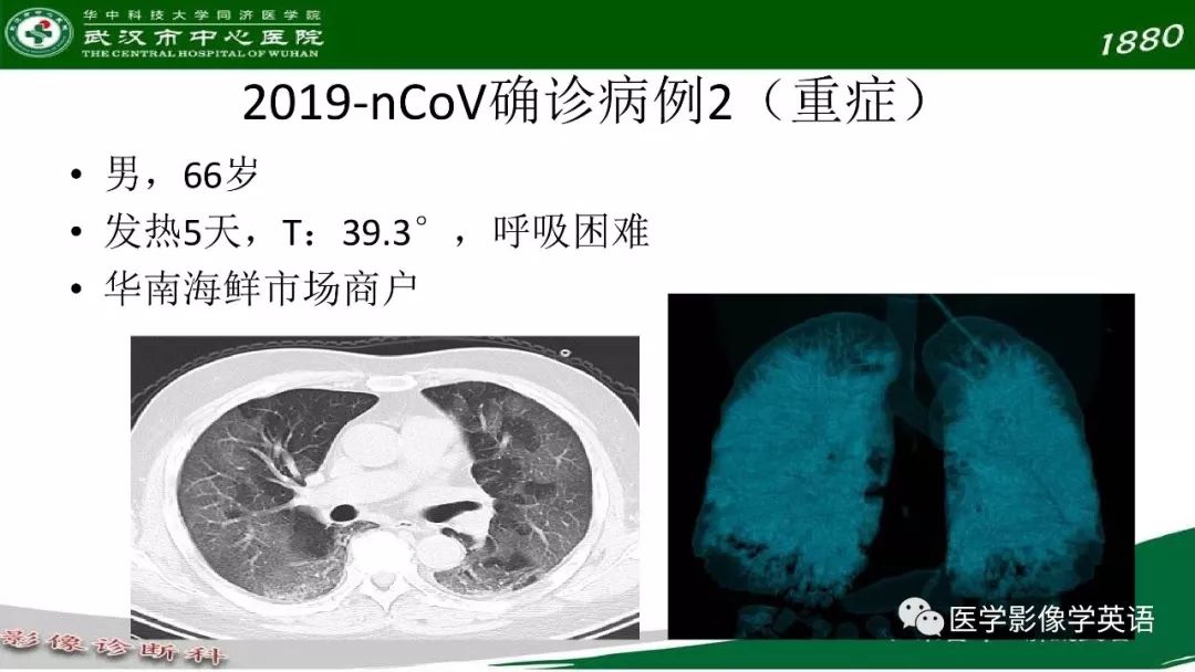 【PPT】易被忽视的疑似2019-nCoV病毒性肺炎
