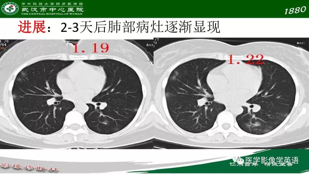 【PPT】易被忽视的疑似2019-nCoV病毒性肺炎